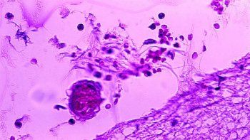 signos de alerta para detectar la meningitis en los ninos