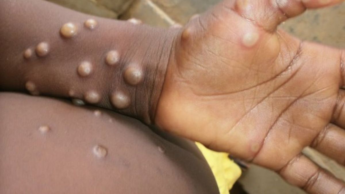 Spain records its second death from monkeypox
