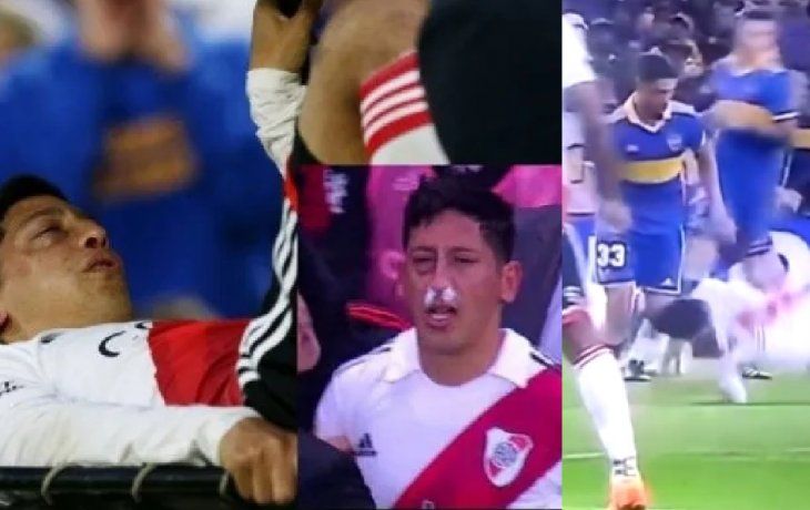 operaron a aliendro tras la fractura que le hizo varela: ¿cuantos meses estara afuera?