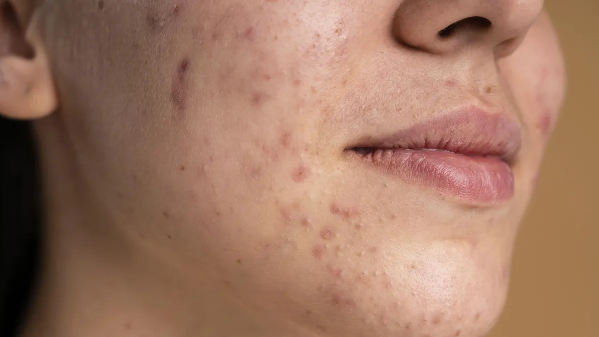 Acne in adults: why does it persist even if we are not teenagers?