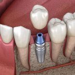 Los riesgos y complicaciones de los implantes dentales, según los especialistas. Los riesgos y complicaciones de los implantes dentales, según los especialistas.