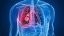 Crecen los casos de enfermedades respiratorias en Argentina.