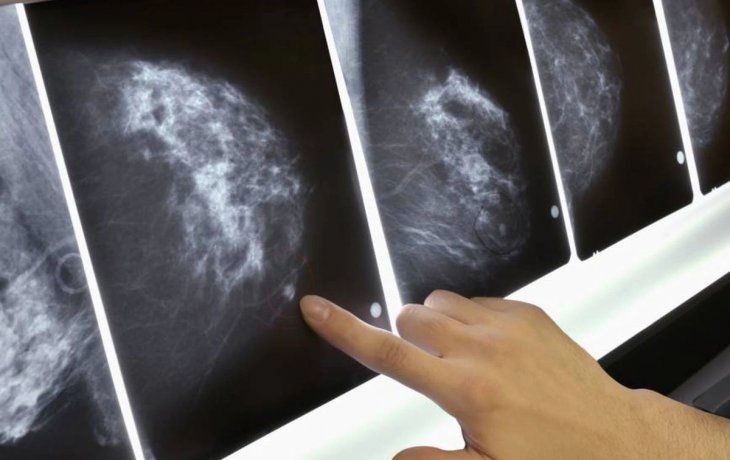 Cáncer de mama.