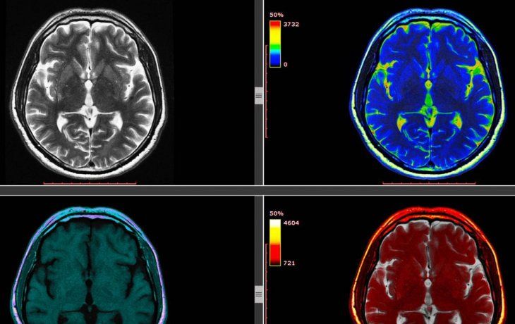 Cerebro.