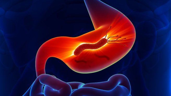 Los especialistas informaron que la infección se produce por una bacteria “silenciosa” que reside en el estómago.