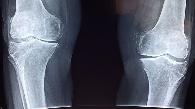 Osteoporosis.