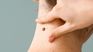 Skin cancer Skin cancer