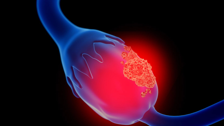Cerca del 70% de los casos se detecta en estadios avanzados, lo que limita las posibilidades de curación. Cerca del 70% de los casos se detecta en estadios avanzados, lo que limita las posibilidades de curación.