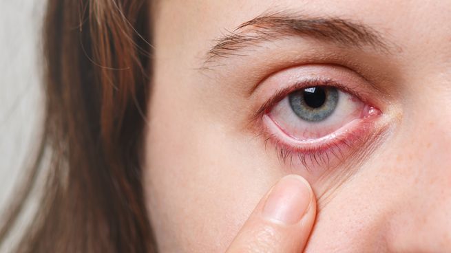 concepto-medicina-cuidado-salud-vista-hembra-irreconocible-muestra-su-ojo-rojo-inflado-capilar-sangre.jpg