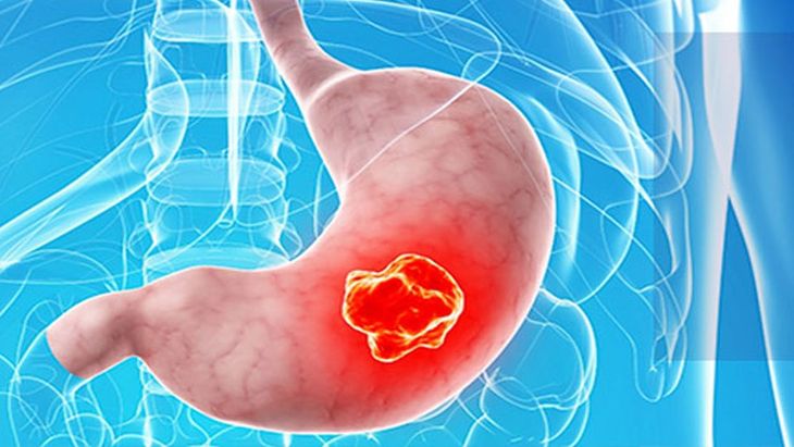 Gastric cancer is abnormal cell growth in stomach lining that usually originates in the mucosa. Gastric cancer is abnormal cell growth in stomach lining that usually originates in the mucosa.