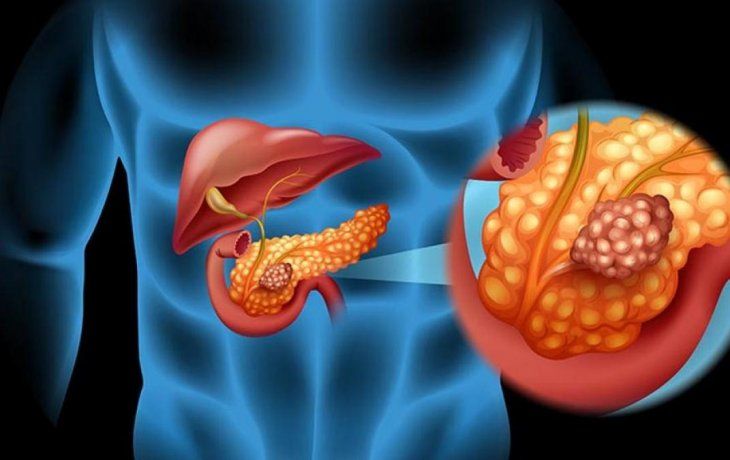 El adenocarcinoma ductal de páncreas es el tipo más habitual de la enfermedad y suele diagnosticarse tarde. El adenocarcinoma ductal de páncreas es el tipo más habitual de la enfermedad y suele diagnosticarse tarde.
