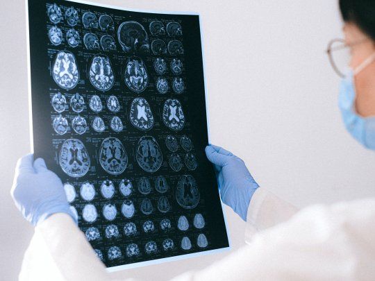 cerebro neurologia coronavirus.jpg