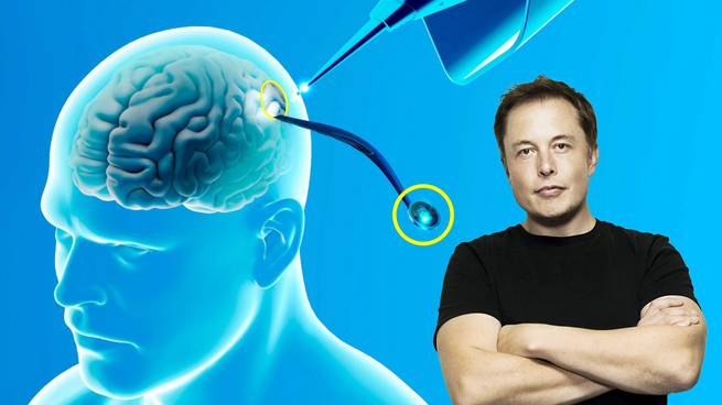 Elon Musk, dijo que el primer humano recibió un implante cerebral de su empresa Neuralink.