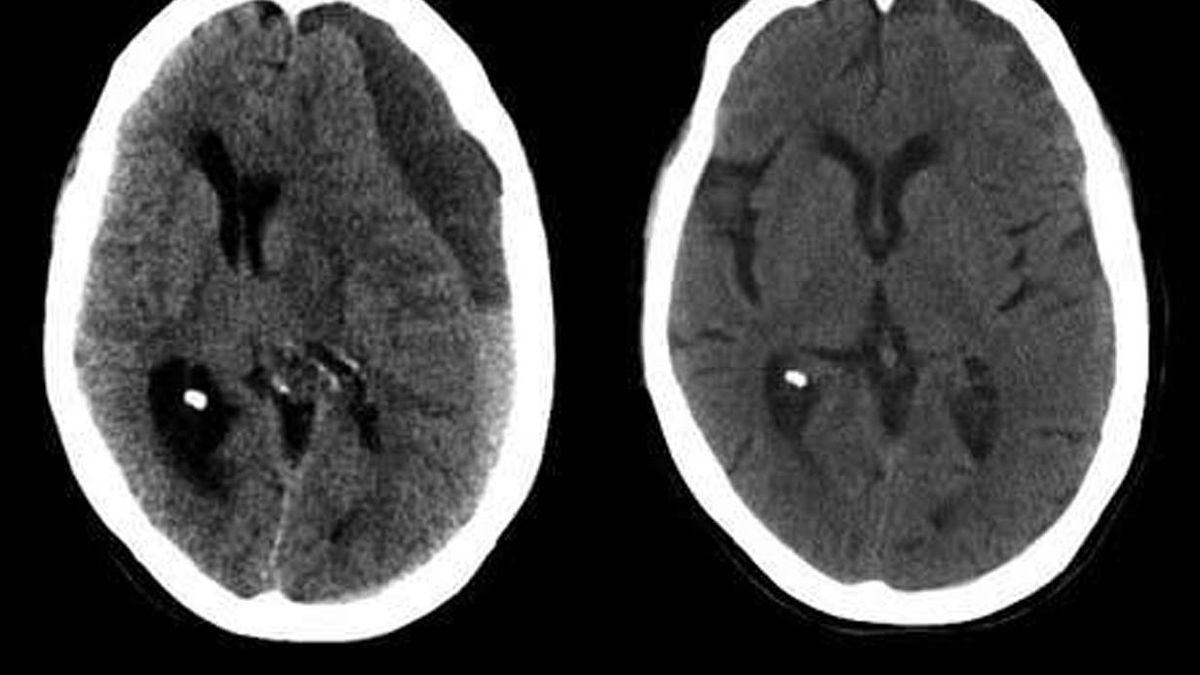 hematoma subdural que une las venas