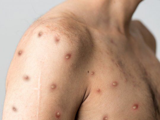 La viruela del mono pone el alerta al sistema de salud en todo el mundo.
