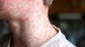 Measles cases have already reached 26 throughout the country. Measles cases have already reached 26 throughout the country.