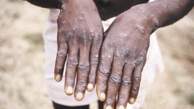 Efectos. Esta enfermedad se manifiesta con llagas, como la varicela, pero más purulentas. Los contagios se producen entre personas.