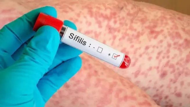 El Boletín Epidemiológico Nacional alertó sobre una suba sostenida de los casos de sífilis y volvió a poner el foco en la prevención, el diagnóstico temprano y el acceso oportuno al tratamiento.