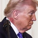 La lesión rojiza fue visible debajo de la oreja derecha durante recientes actos públicos. La lesión rojiza fue visible debajo de la oreja derecha durante recientes actos públicos.