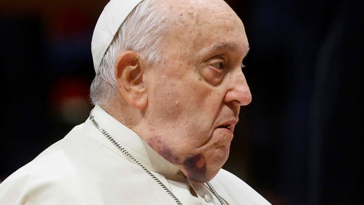 He also suffered two falls recently in his Vatican residence, bruising his chin in December and injuring an arm in January. He also suffered two falls recently in his Vatican residence, bruising his chin in December and injuring an arm in January.