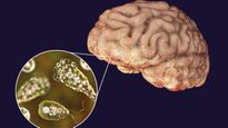 Ameba come-cerebros: qué es y cómo se contrae la infección.
