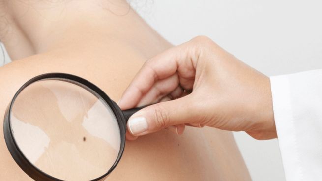 Trabajan contra el melanoma.