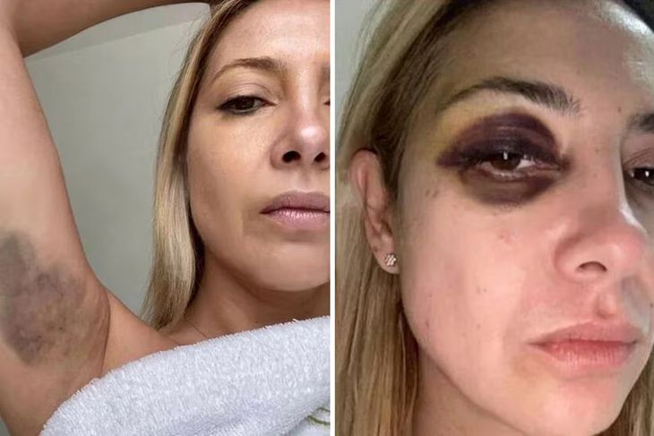 Fotos que documentan las lesiones físicas sufridas por Fabiola Yáñez según consta en el expediente.