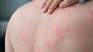 The symptoms of hives can limit daily activities such as sleeping, playing sports, working, and even having sexual relations. The symptoms of hives can limit daily activities such as sleeping, playing sports, working, and even having sexual relations.