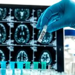 El análisis de sangre que ayuda a tratar el alzheimer de manera temprana. El análisis de sangre que ayuda a tratar el alzheimer de manera temprana.