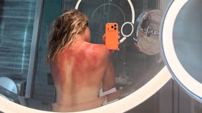 Una tenista encendió las alarmas en el Abierto de Australia por las quemaduras del Sol en su espalda