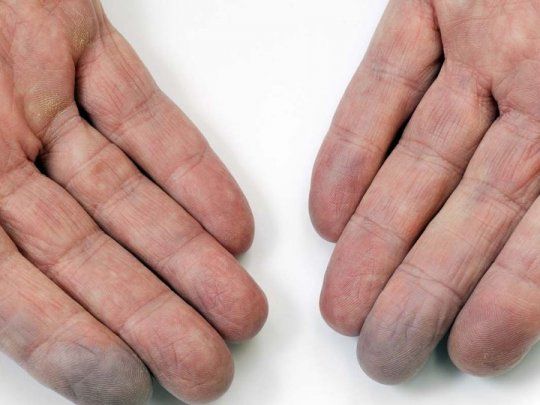 Uno de los principales signos de la esclerodermia es el S&iacute;ndrome de Raynaud, en las campa&ntilde;as conocidos como los dedos azules.