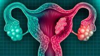 Un nuevo estudio reduce el riesgo de muerte en paciente con cáncer de útero.&nbsp;