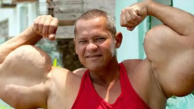 Arlindo de Souza, conocido como el “Popeye brasileño”, se hizo famoso por inyectarse aceite mineral en los brazos para aumentar el volumen muscular.