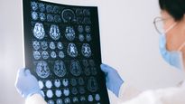 UNAM: un gran avance en la investigación de la enfermedad de Parkinson