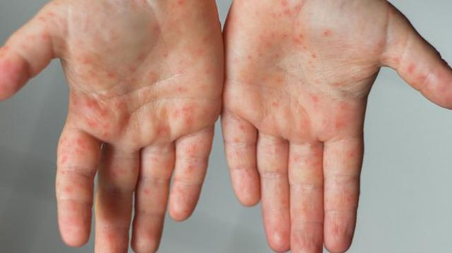 Viruela del mono.jpeg