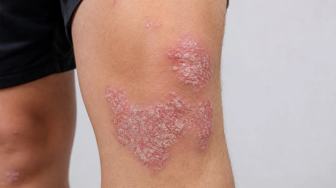 &nbsp;Las lesiones suelen aparecer en codos, rodillas y cuero cabelludo. El diagnóstico dermatológico permite definir el tratamiento según la gravedad.