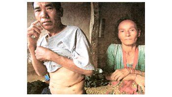 ámbito.com | El campesino Indra Bahadur muestra la cicatriz que le quedó de la ablación de riñón a la que se acaba de someter por 600 euros.