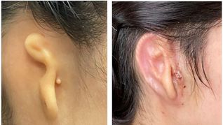 lograron trasplantar una oreja humana creada con una impresora 3d