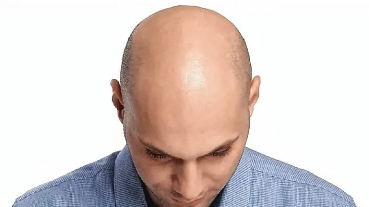 Detrás del Día del Pelado se encuentra una iniciativa que busca la aceptación personal y el abandono de los prejuicios. Detrás del Día del Pelado se encuentra una iniciativa que busca la aceptación personal y el abandono de los prejuicios. 