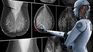 Inteligencia Artificial para detectar el cáncer de mama Inteligencia Artificial para detectar el cáncer de mama