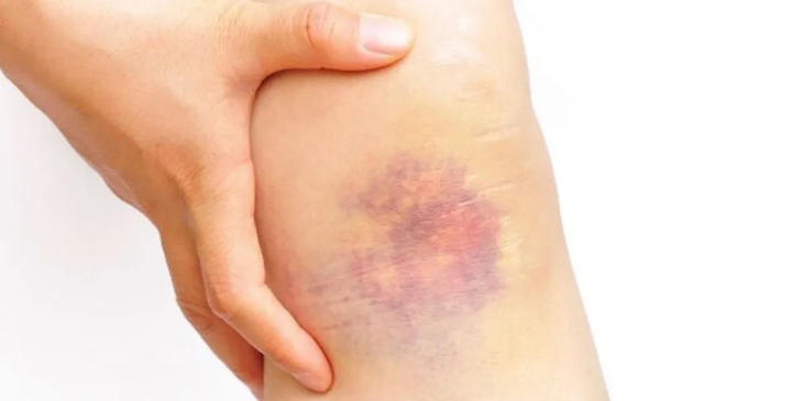 In the first few hours after the injury, applying ice can help reduce swelling and minimize the extent of the bruise.
