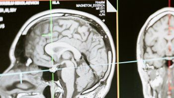 El cerebro está protegido por un líquido transparente