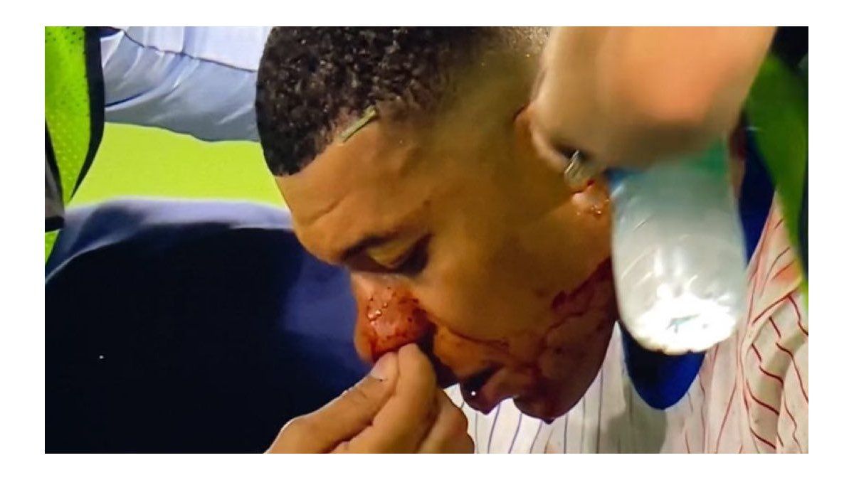 Kylian Mbappé broke his nose, but will wear a mask to continue playing in the Euro Cup