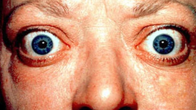 Oftalmología hipertiroidismo.jpg