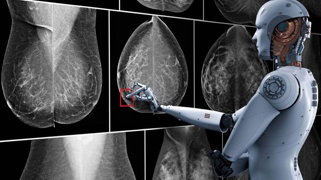 Inteligencia Artificial para detectar el cáncer de mama