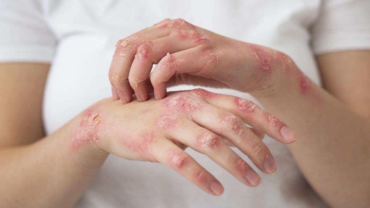 How is scabies spread and what are the symptoms?