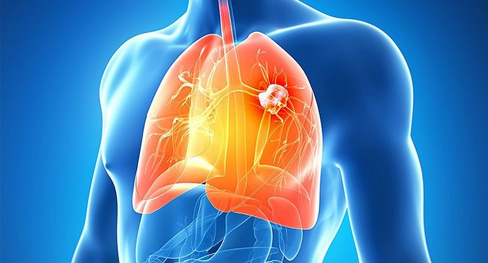 El cáncer de pulmón suele no dar síntomas hasta encontrarse en estadios avanzados. El cáncer de pulmón suele no dar síntomas hasta encontrarse en estadios avanzados.