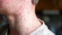 Se intensifica la vacunación para prevenir nuevos casos de sarampión.