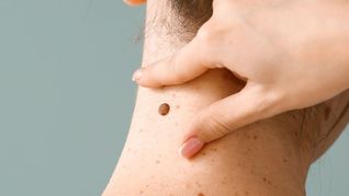 Cáncer de piel