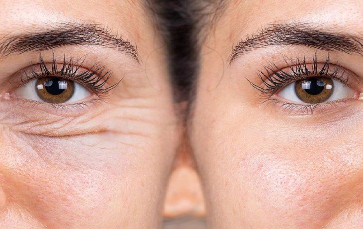 ámbito.com | Cirugía estética párpados.jpg